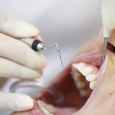 P251 Periodontal Disease: Conservative Management thumbnail