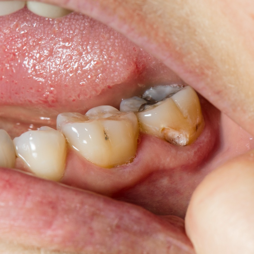 Image representing P379 Challenges in Differential Diagnosis and Treatment of Cervical Root Resorption vs. Root Caries