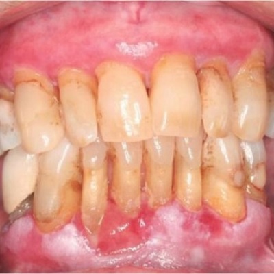 Image representing P690 Aetiology of Gingivitis