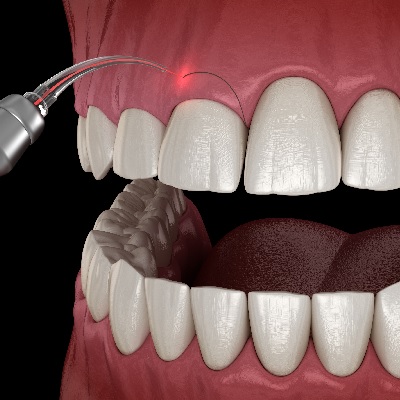 Image representing P005 Gingival Design and Conditioning in the Aesthetic Zone